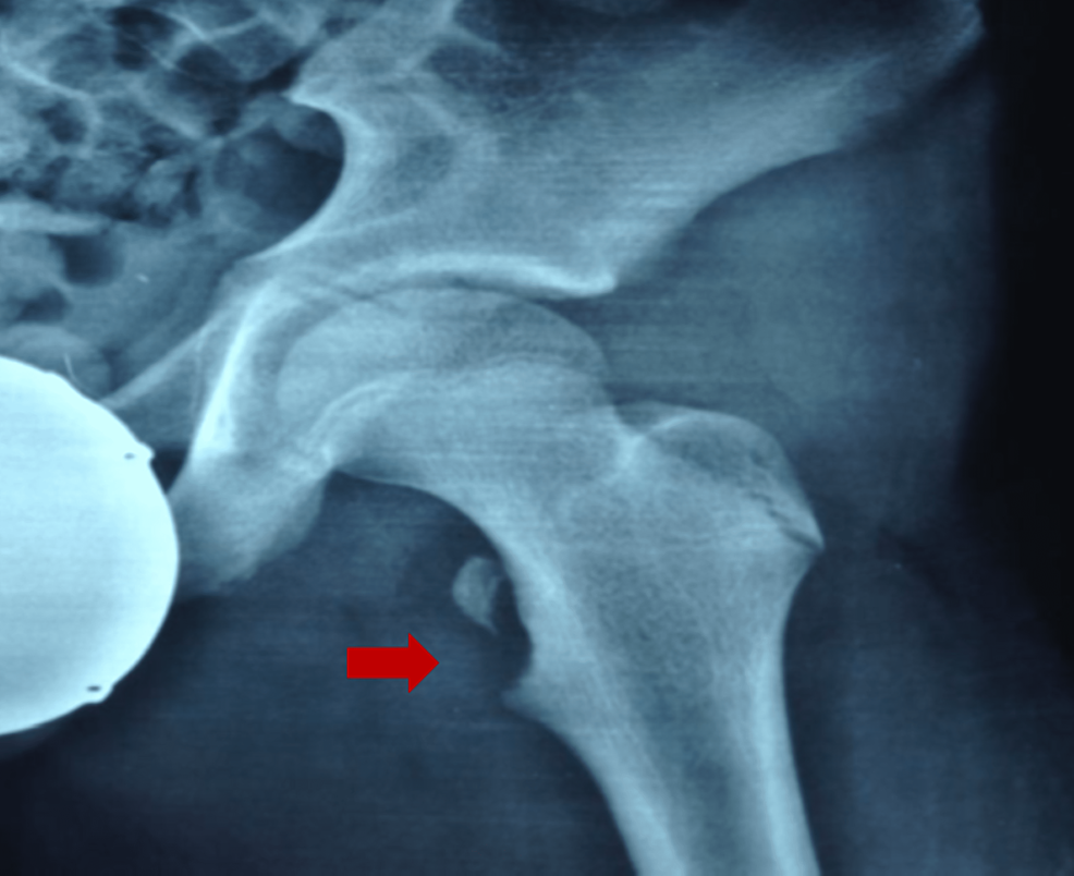 Iliac crest apophyseal avulsion fracture, Radiology Case