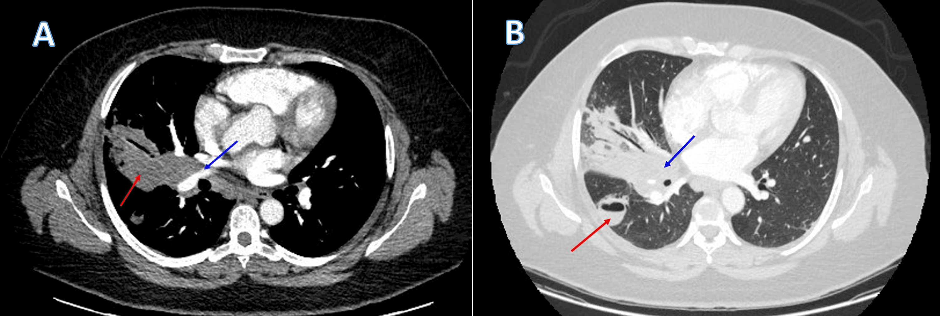 Chronic Cavitary Pulmonary Histoplasmosis In An Immunocompetent Patient ...