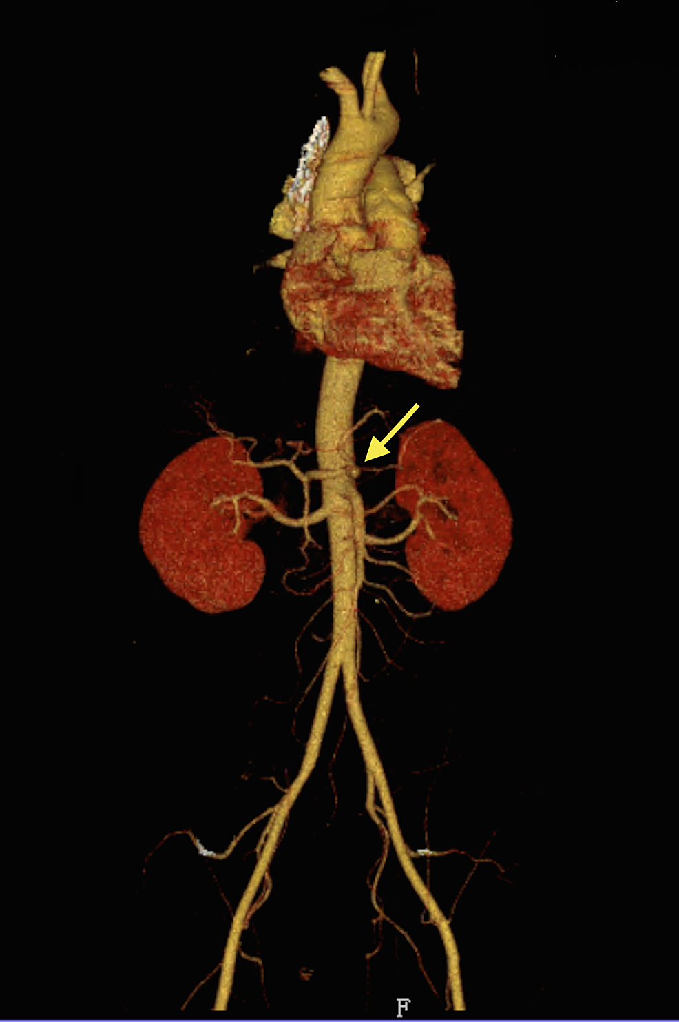 Cureus | Celiac Artery Dissection in a Young Smoker