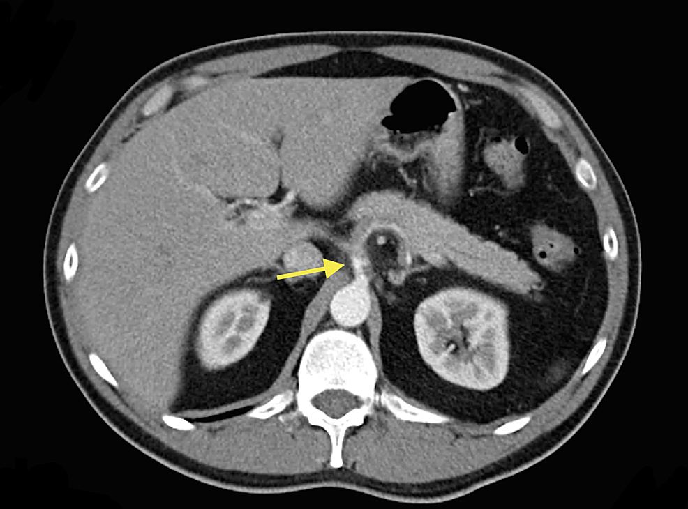 Celiac Artery Vasculitis Radiology