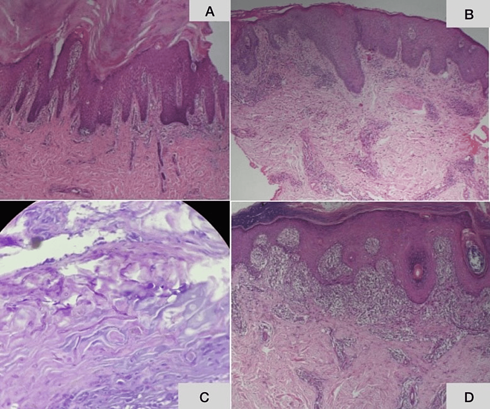 A Clinico-Epidemiological Study Of Hyperkeratotic Palmoplantar Lesions ...