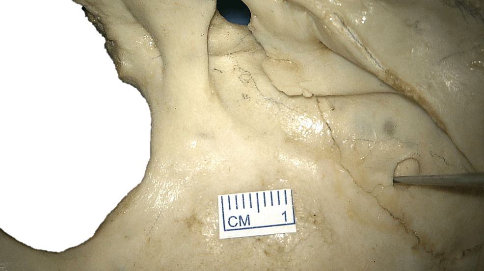 Cureus Granular Foveolae in the Groove of the Sigmoid Sinus An