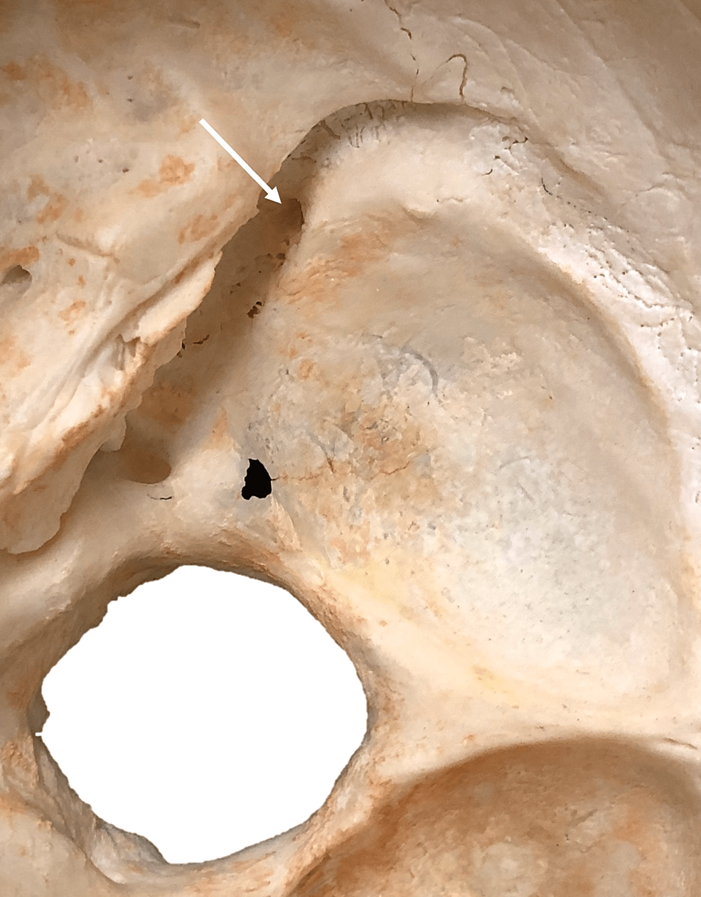 Cureus Granular Foveolae in the Groove of the Sigmoid Sinus An