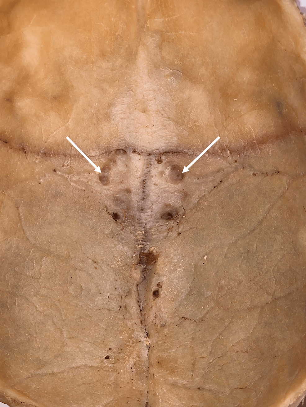 Cureus Granular Foveolae in the Groove of the Sigmoid Sinus An