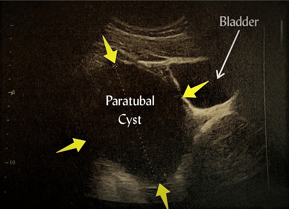 Torsion of paratubal cyst mimicking ovarian torsion: A rare case of  difficult diagnosis - ScienceDirect