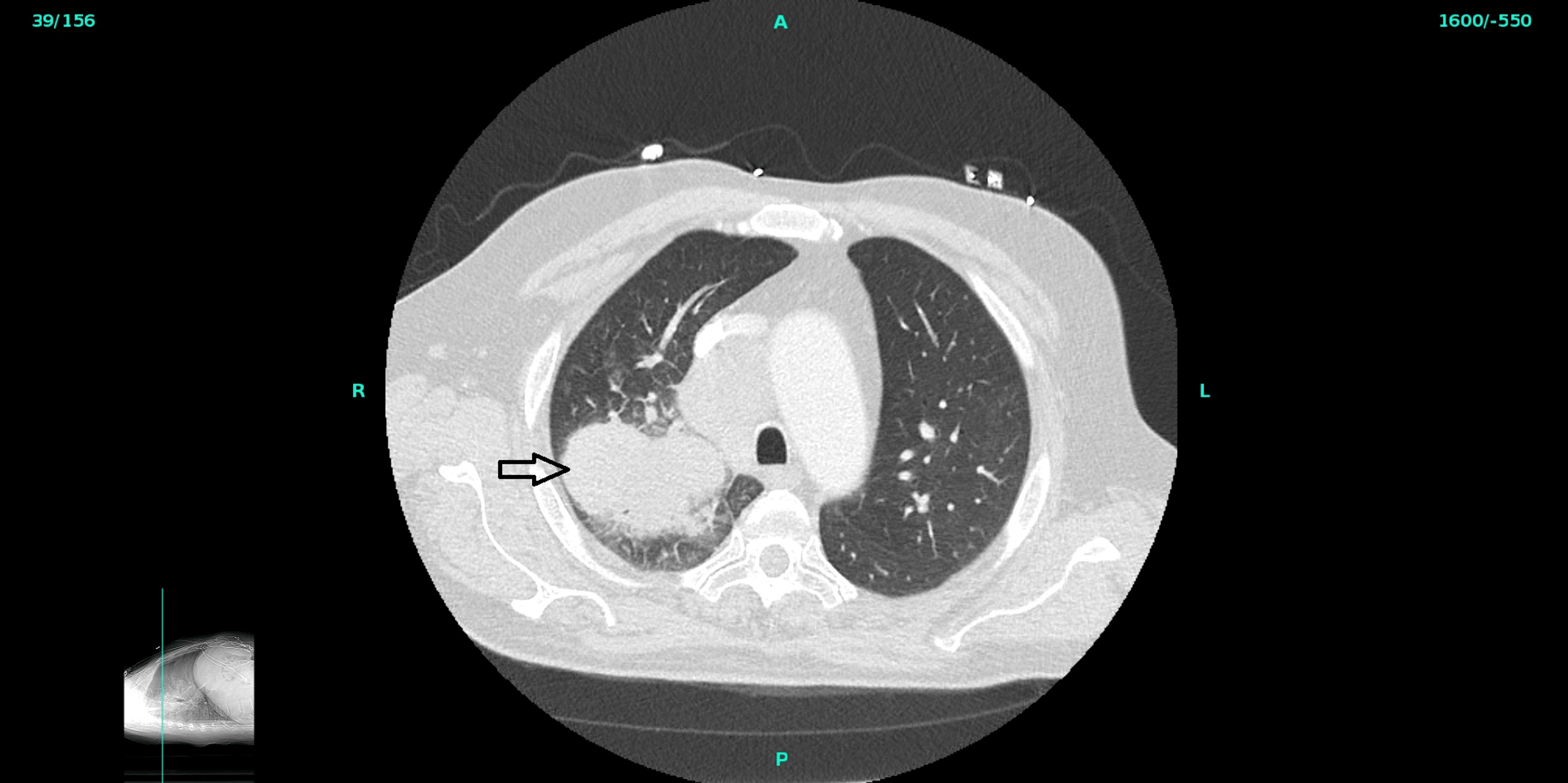 Cureus Primary Malignant Melanoma of the Lung (PMML); A Case Report