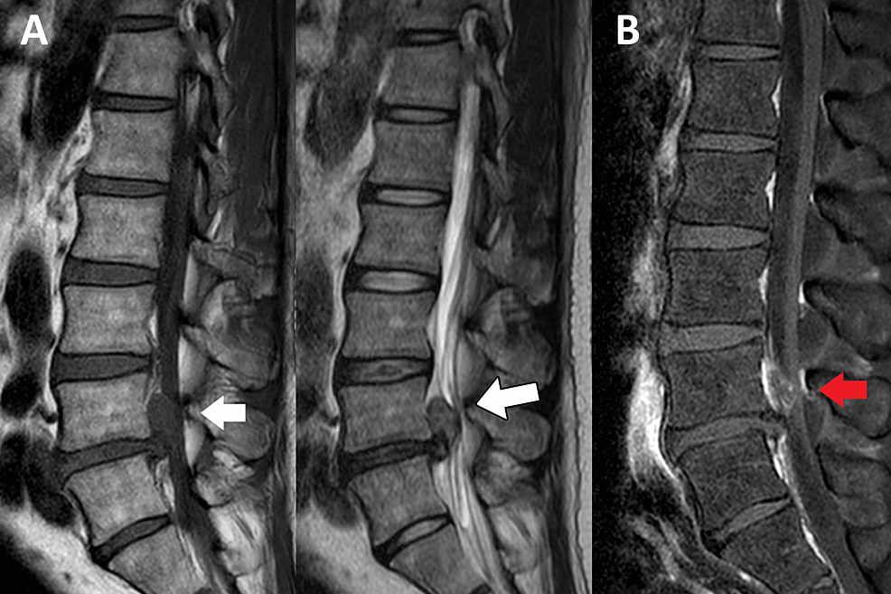 Lumbar Spine Mri Bulging Disc
