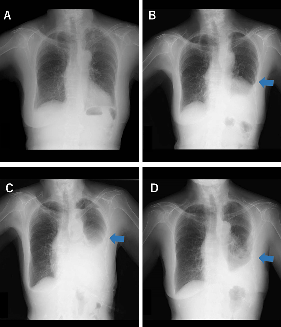 Cureus Intractable Pleural Effusion After Stereotactic Ablative