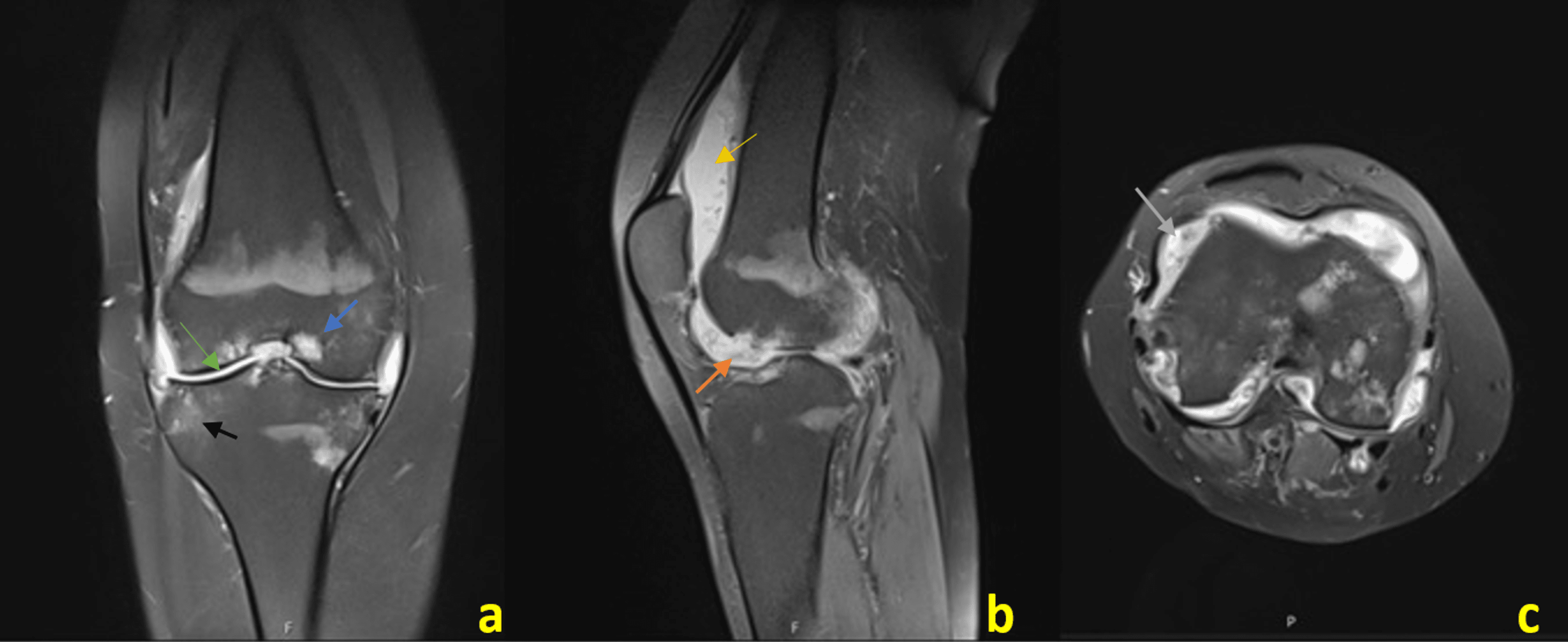 Tuberculosis Presenting As Chronic Monoarthritis: A Case Study 