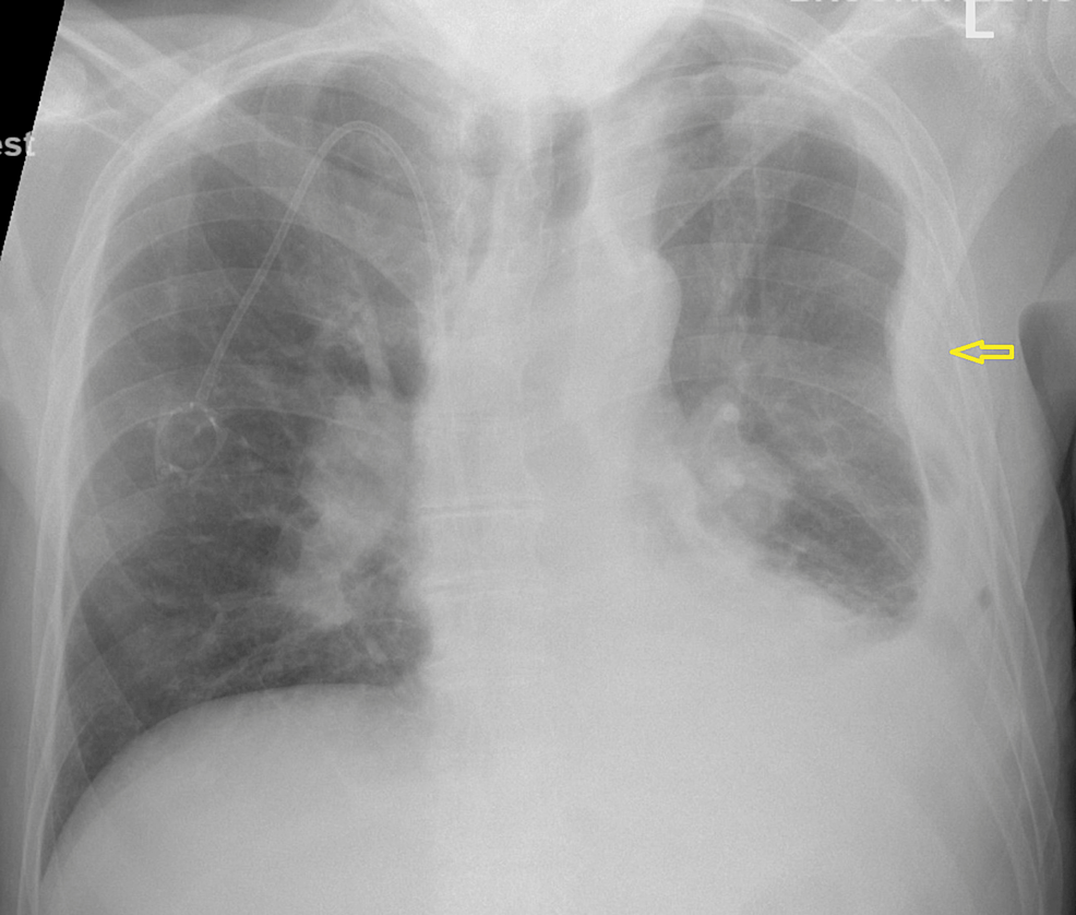 Initial Chest Radiograph Revealing Large Loculated Pl vrogue.co