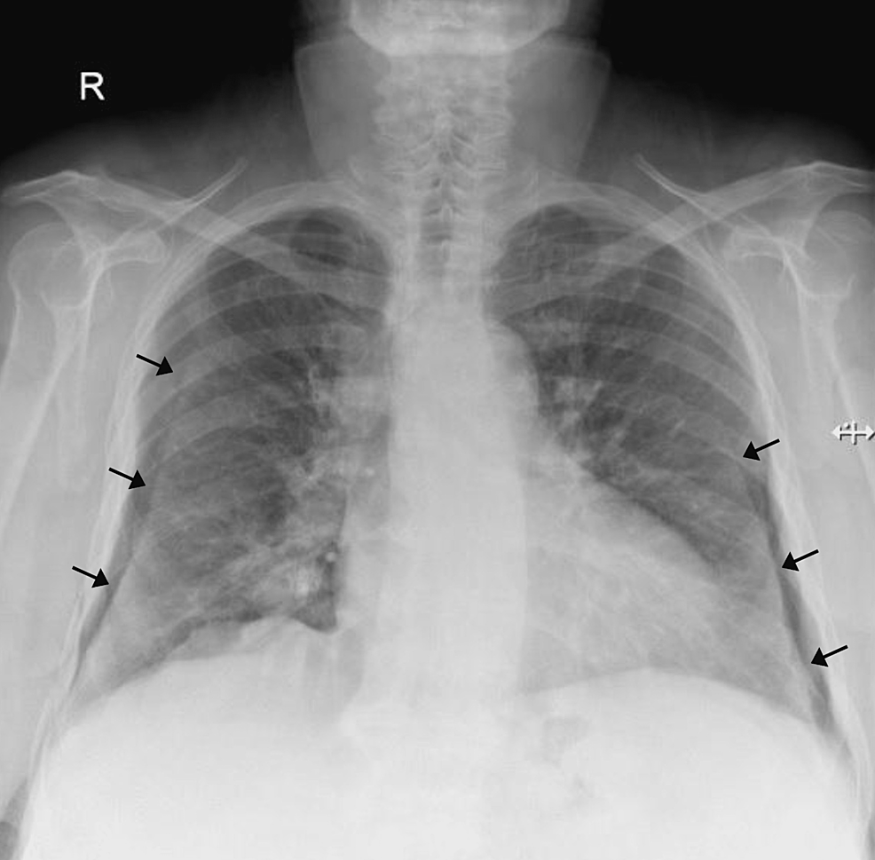 pseudo-pneumothorax-due-to-skin-folds-in-a-patient-with-pneumonia-cureus