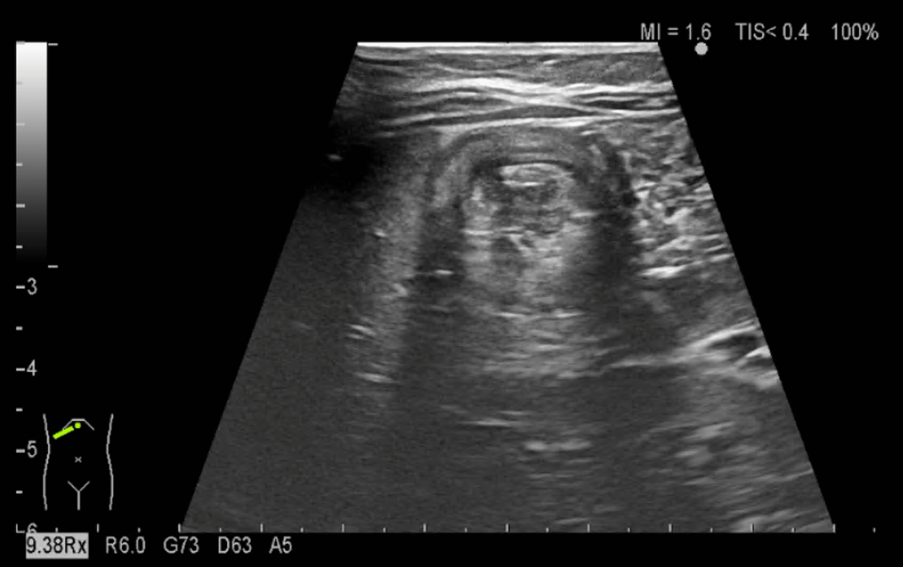 Cureus Intussusception Initially Diagnosed as a Brief Resolved