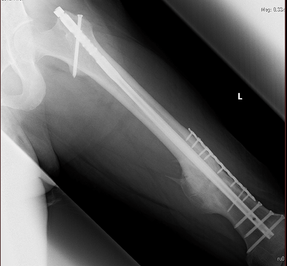 Gluteal Compartment Syndrome After Femoral Nail Extraction A Case