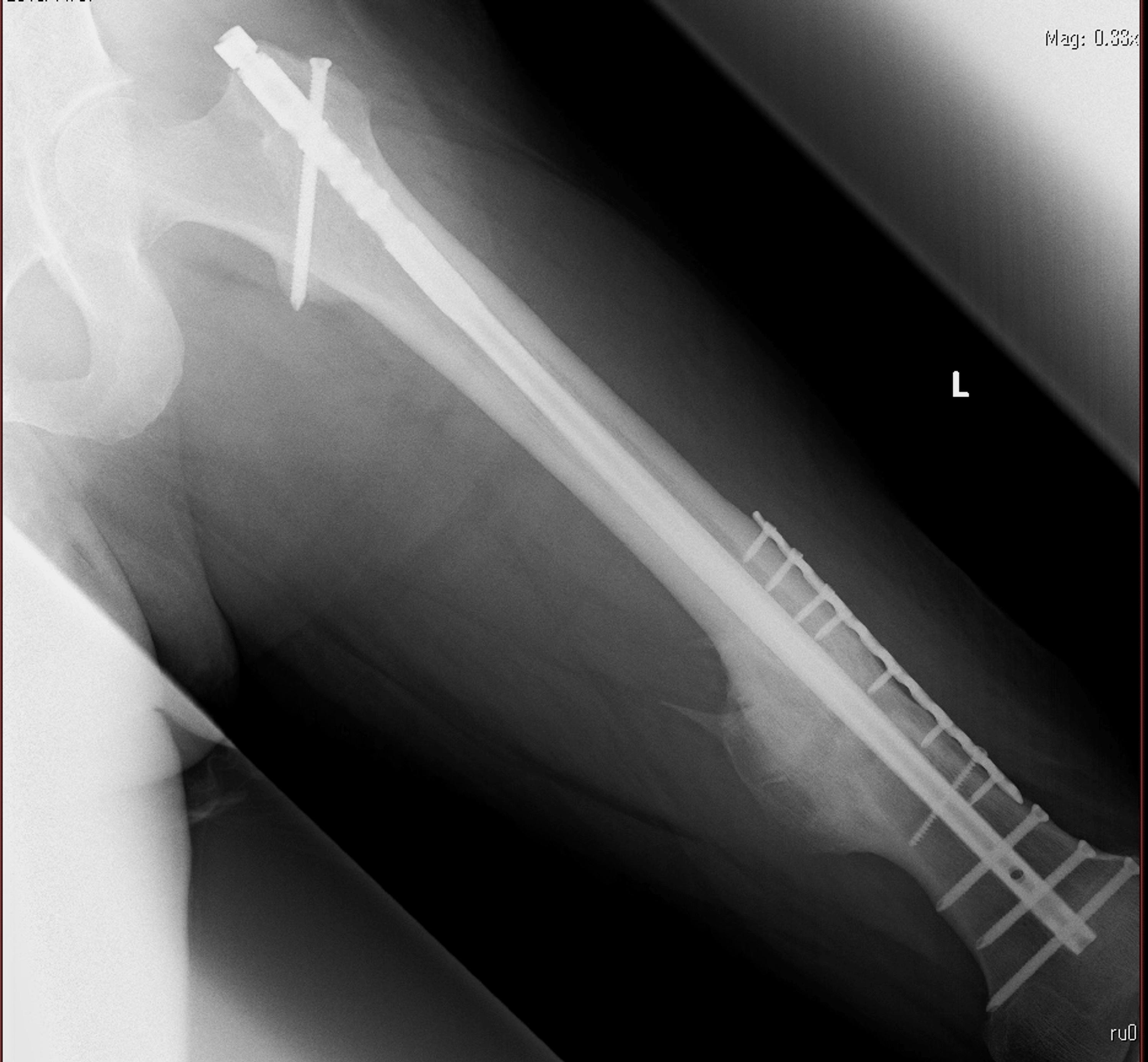 Gluteal Compartment Syndrome After Femoral Nail Extraction A Case Report Cureus