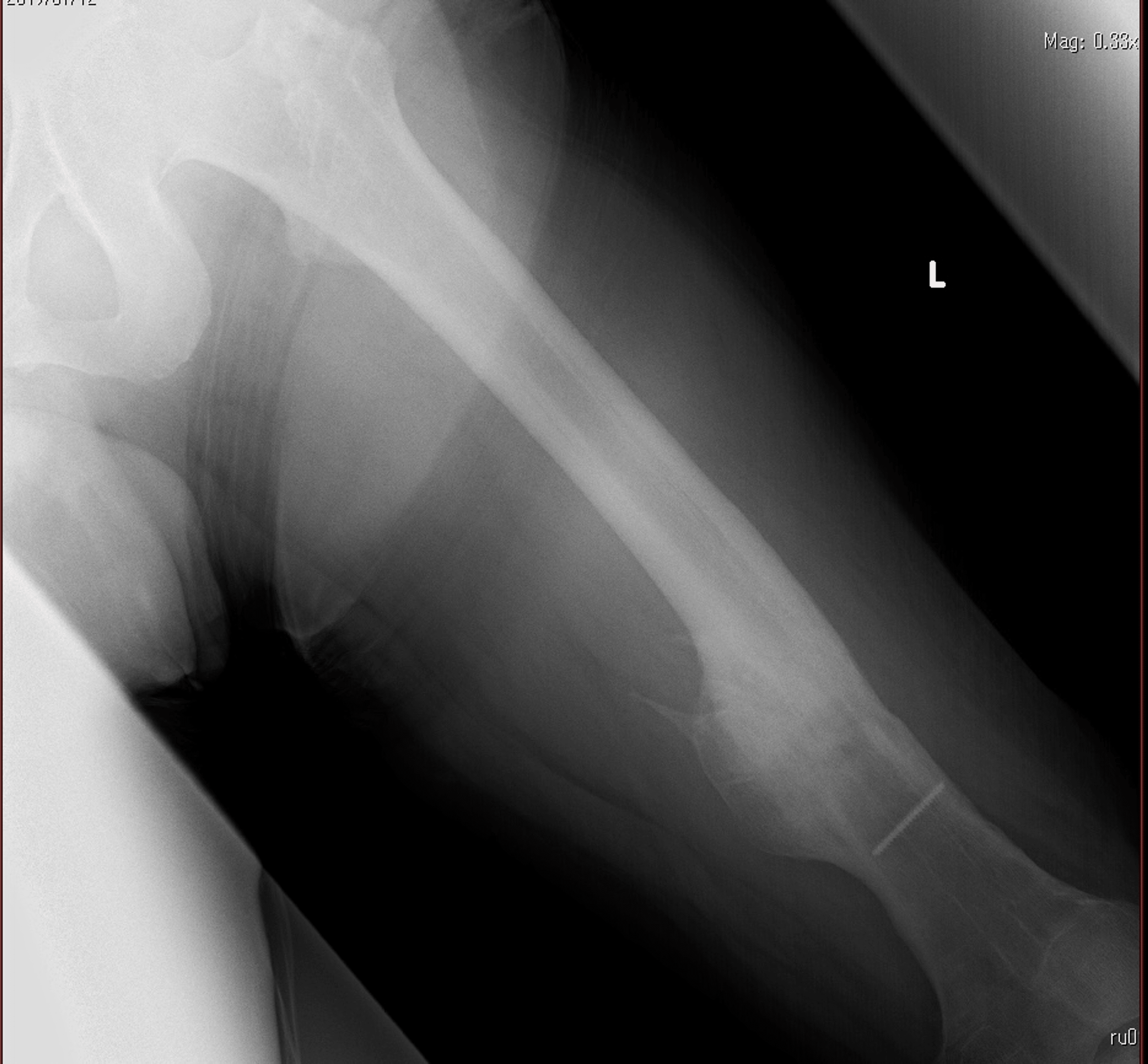Gluteal Compartment Syndrome After Femoral Nail Extraction A Case Report Cureus