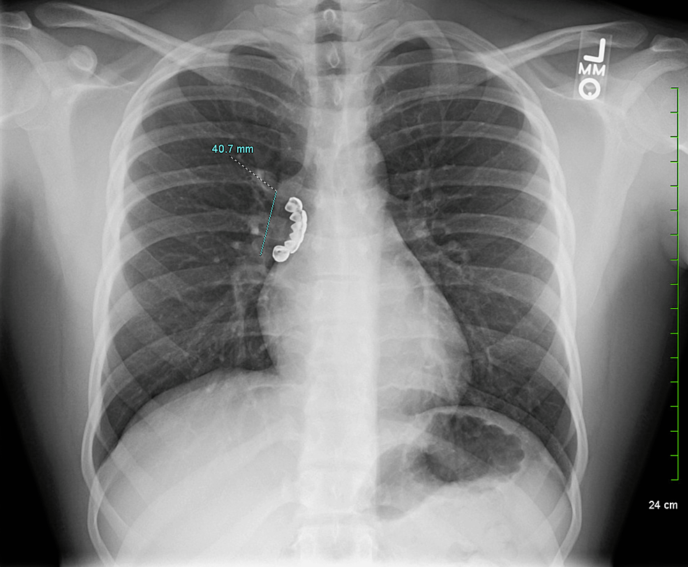 Начальная рентгенография грудной клетки