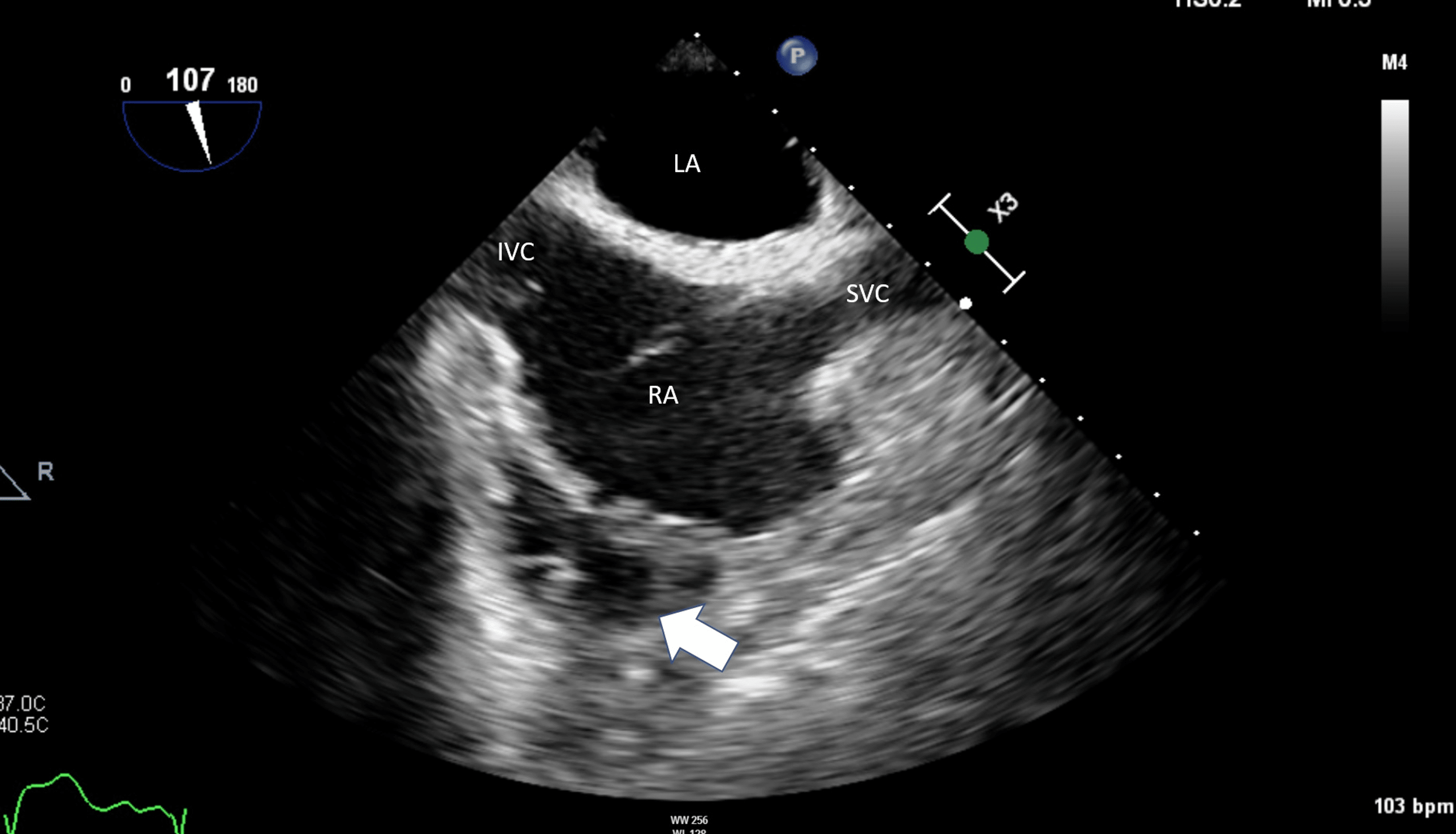 Cureus | A Case of Cutibacterium acnes Pericardial Effusion After ...