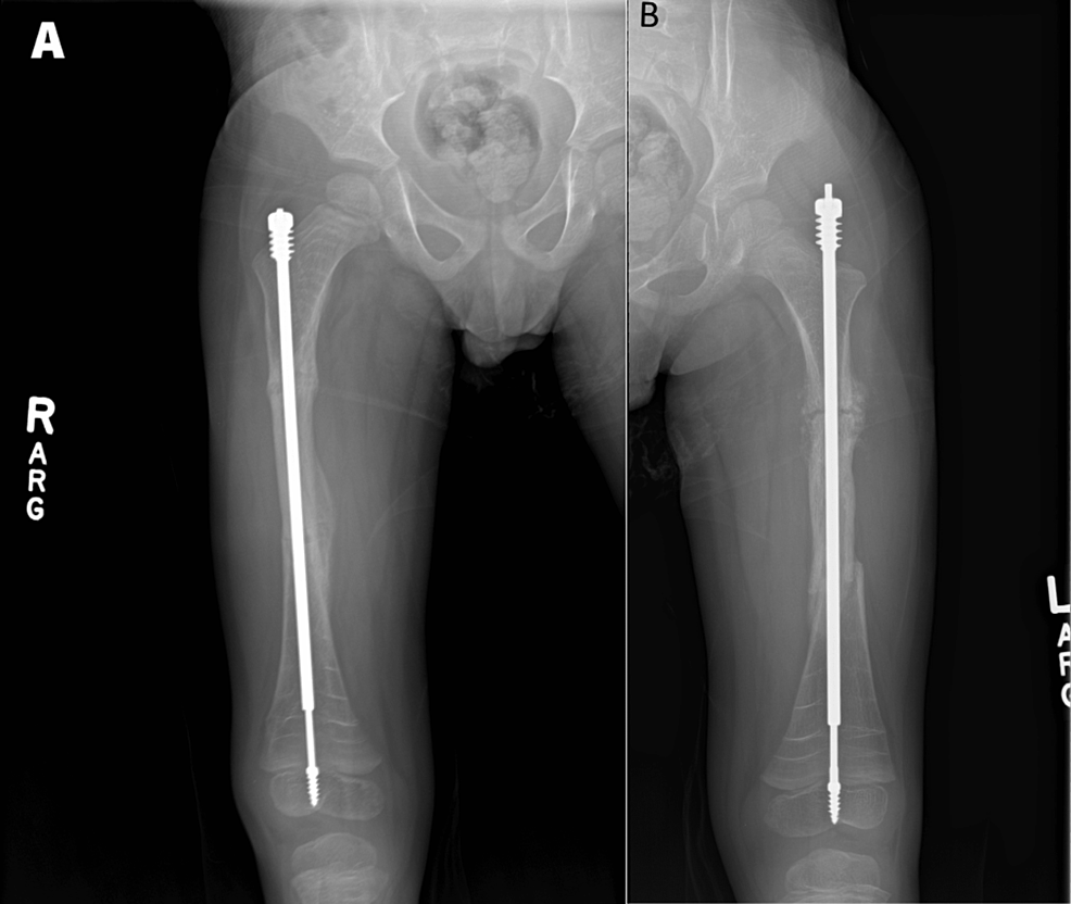 A Fracture From A Physical Exam A Case Report Of Osteogenesis