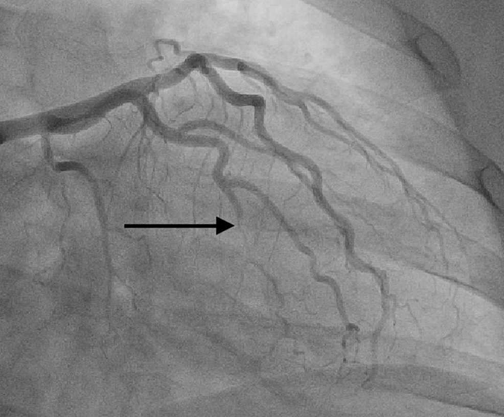 Is Spontaneous Coronary Artery Dissection Hereditary