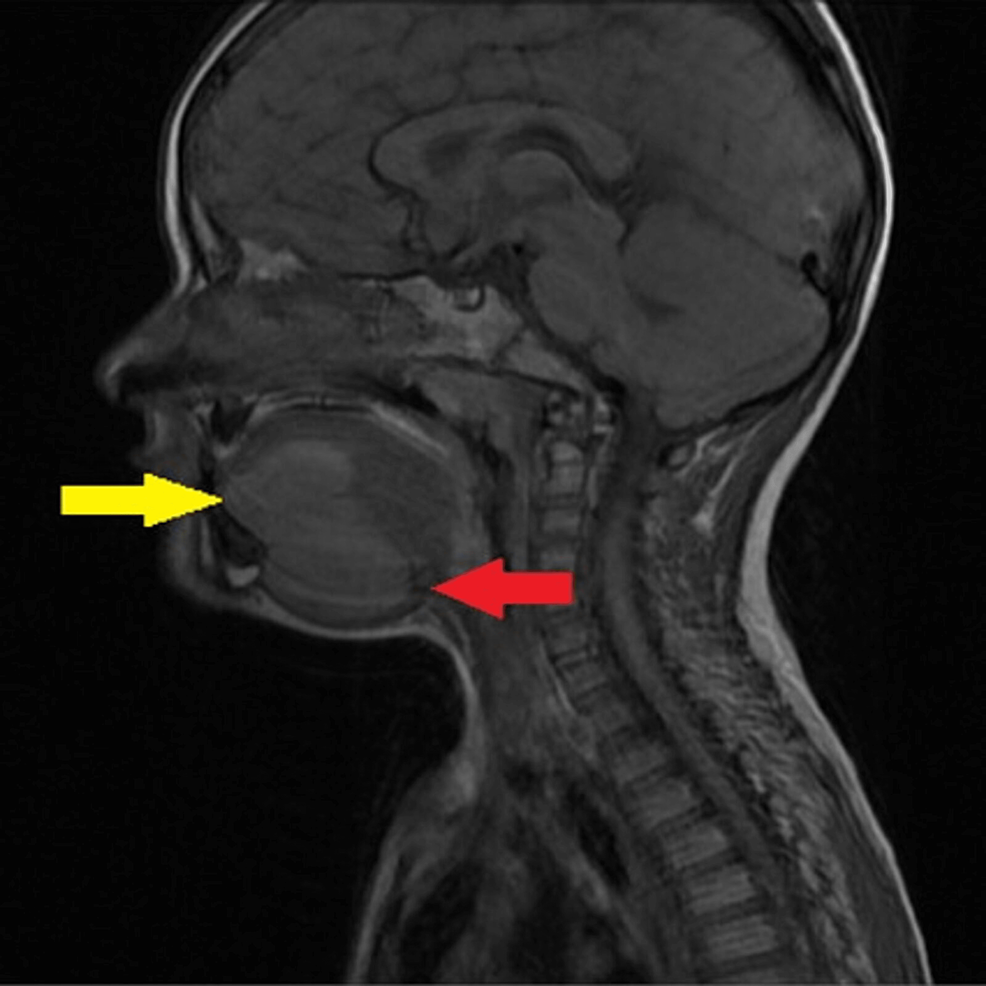 Cureus A Rare Case of Congenital Plunging Ranulas Diagnosis With