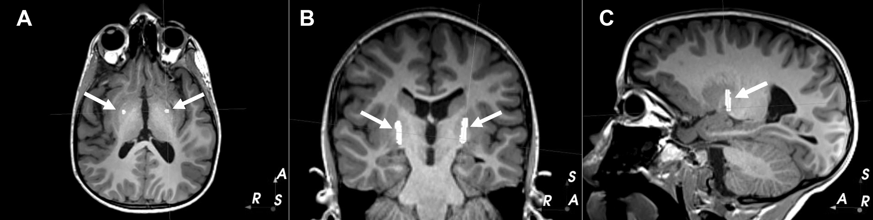 Cureus SingleElectrode Deep Brain Stimulation of Bilateral