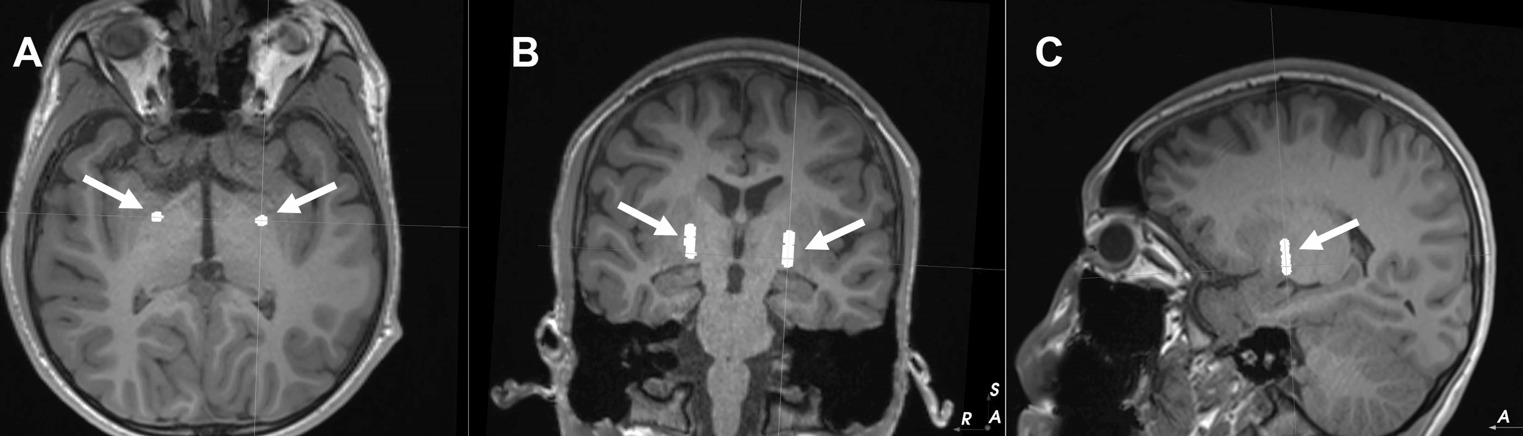SingleElectrode Deep Brain Stimulation of Bilateral Posterolateral