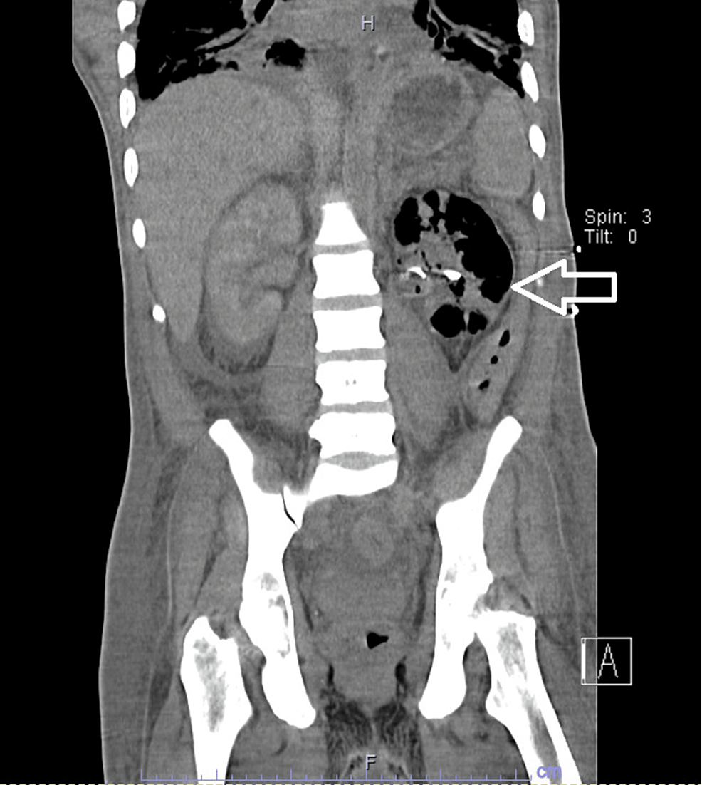 The Importance of Early Imaging in Acute Pyelonephritis A Case Report