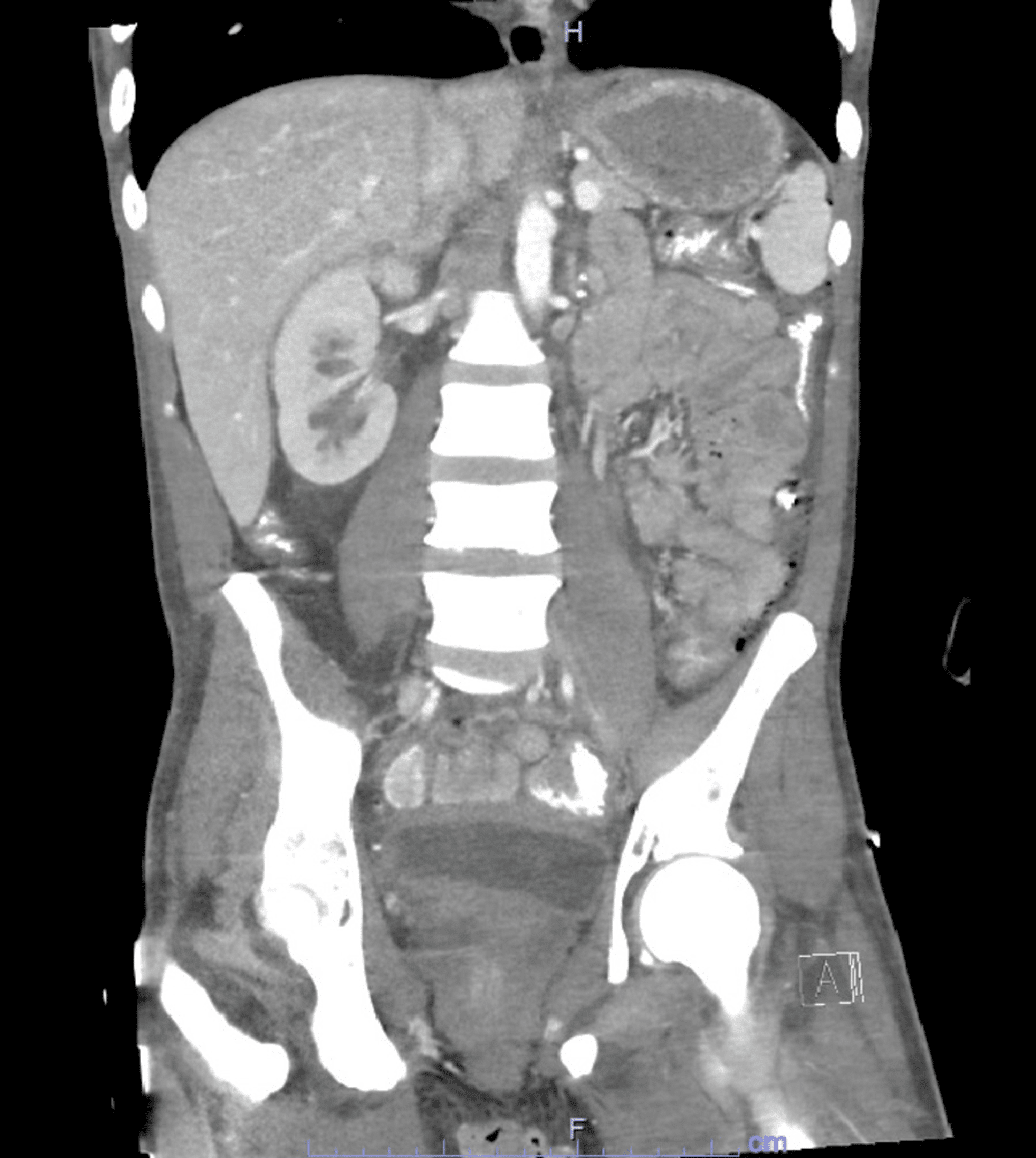 The Importance of Early Imaging in Acute Pyelonephritis A Case Report