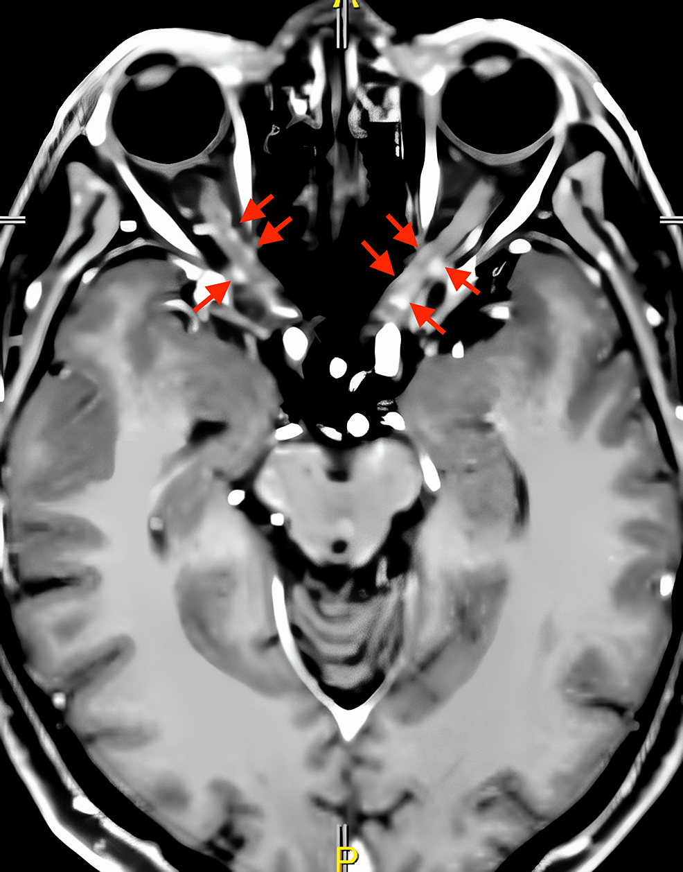 cureus-primary-central-nervous-system-lymphoma-presenting-as-optic