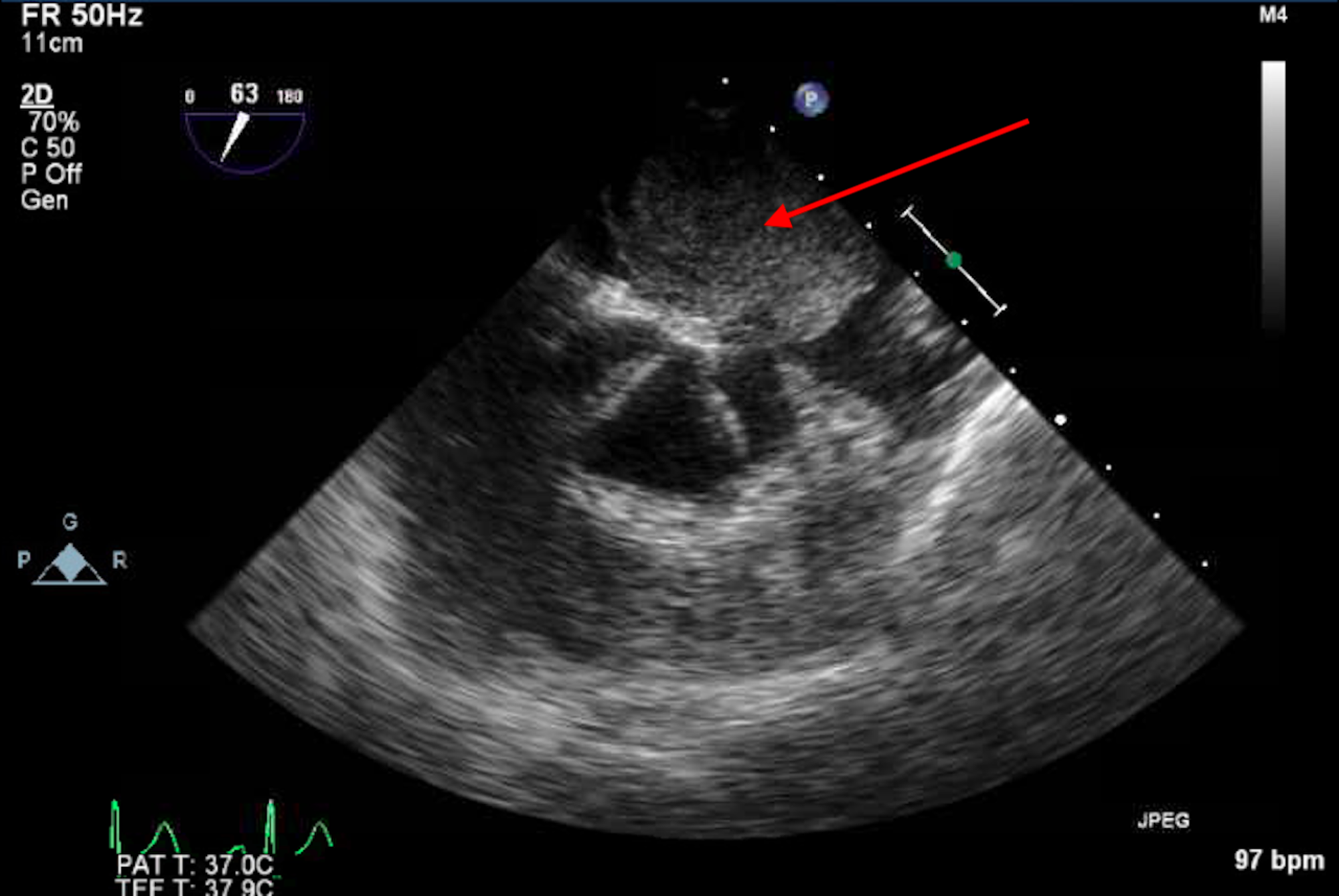 Cureus | Atrial Myxoma Presenting with Palpitations: A Case Report