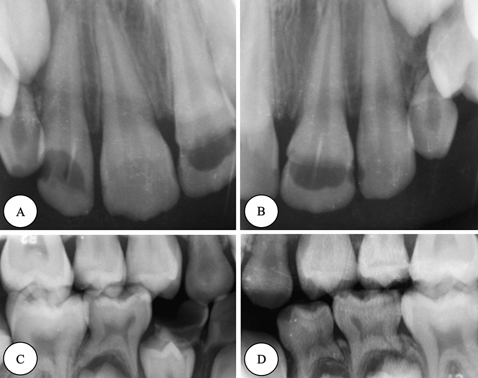 Cureus Comprehensive Dental Management of a Rolandic Epilepsy Patient Under Local Anesthesia
