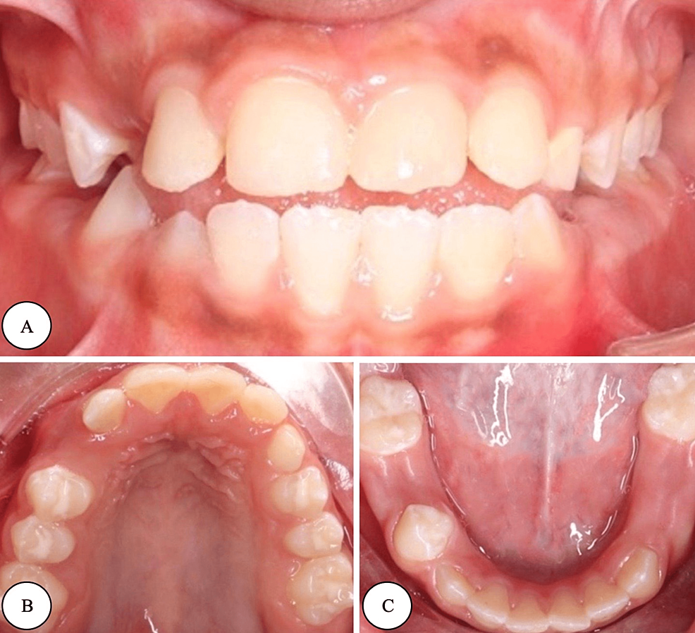 Cureus Comprehensive Dental Management of a Rolandic Epilepsy Patient
