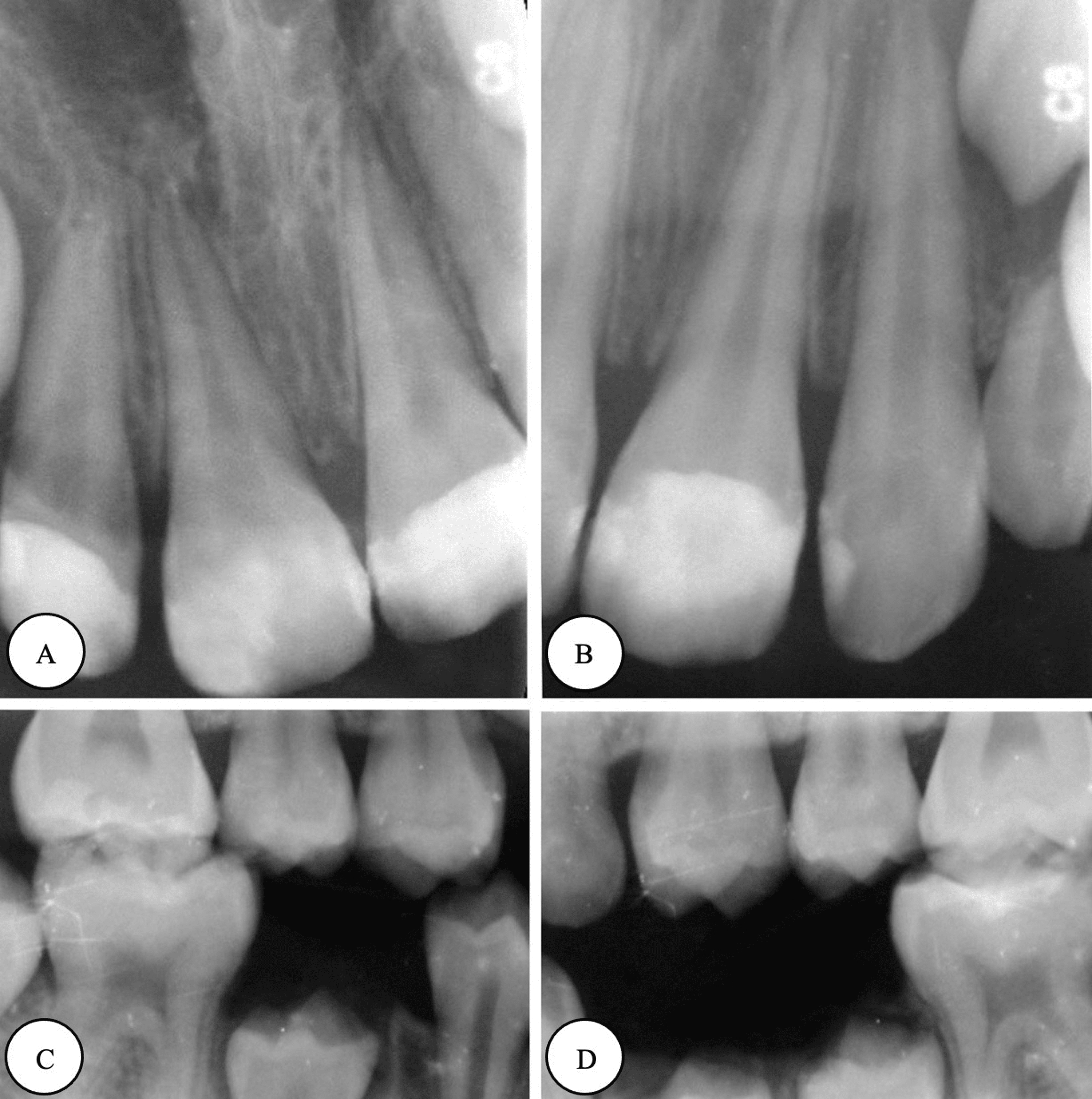 Cureus Comprehensive Dental Management of a Rolandic Epilepsy Patient