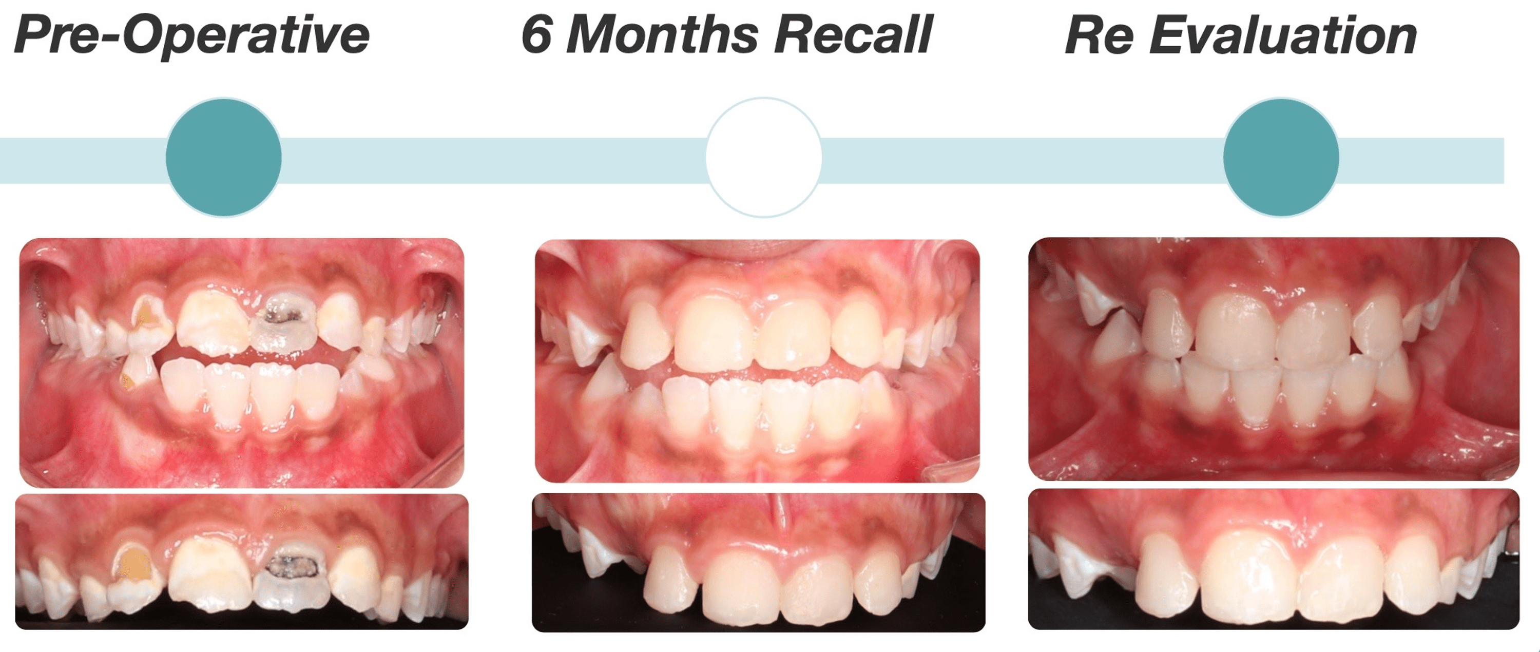 Cureus Comprehensive Dental Management of a Rolandic Epilepsy Patient