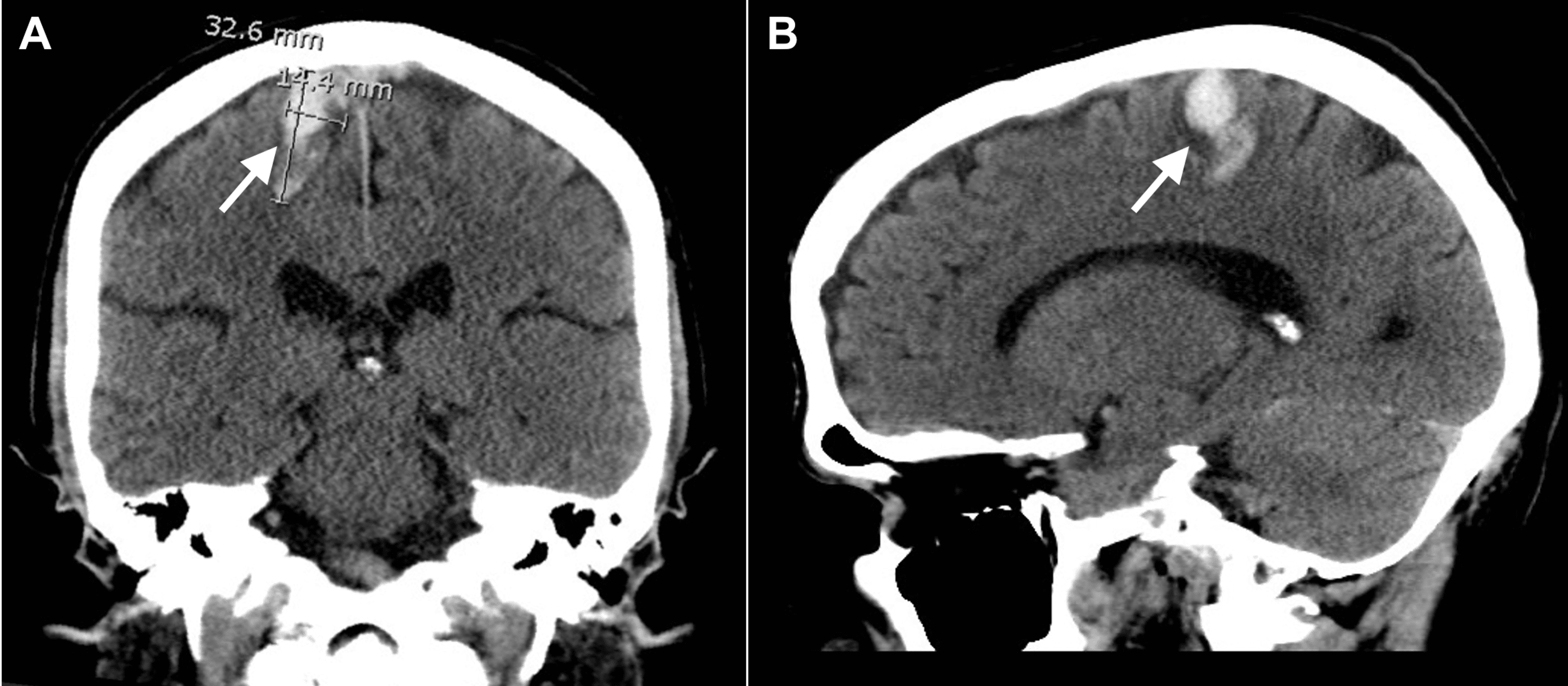 Isolated Lower Limb Weakness Following Hemorrhagic Stroke A Case