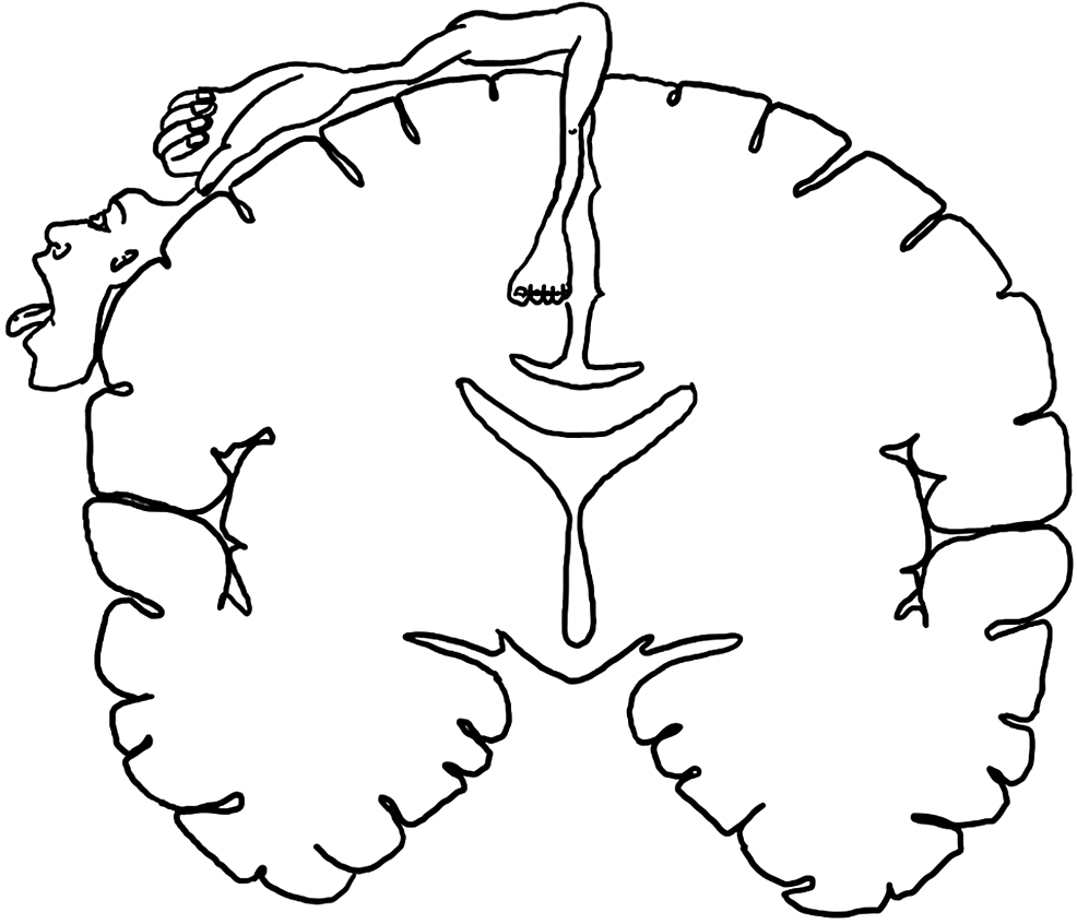 Isolated Lower Limb Weakness Following Hemorrhagic Stroke A Case