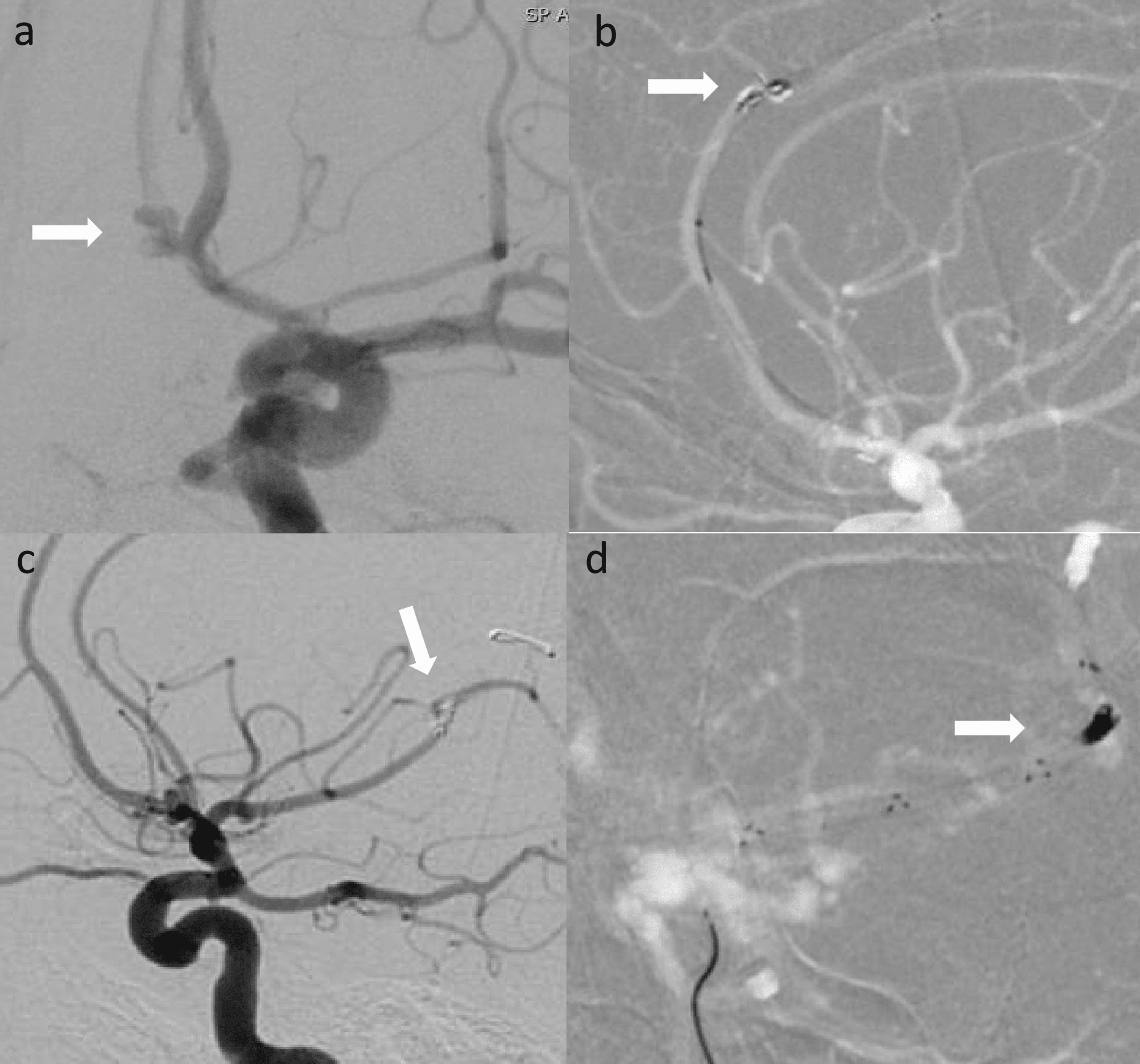 Cureus | Retrieval of Migrated Coils From Distal Cerebral Vasculature ...