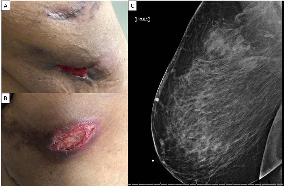 Lesions between breasts