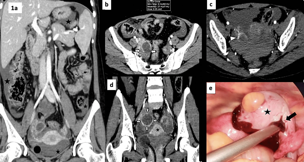 Ruptured ovarian hemorrhagic cyst, Radiology Case
