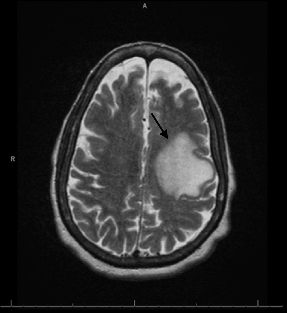 Cureus Glioblastoma Multiforme in a Patient With Alpha1Antitrypsin Deficiency
