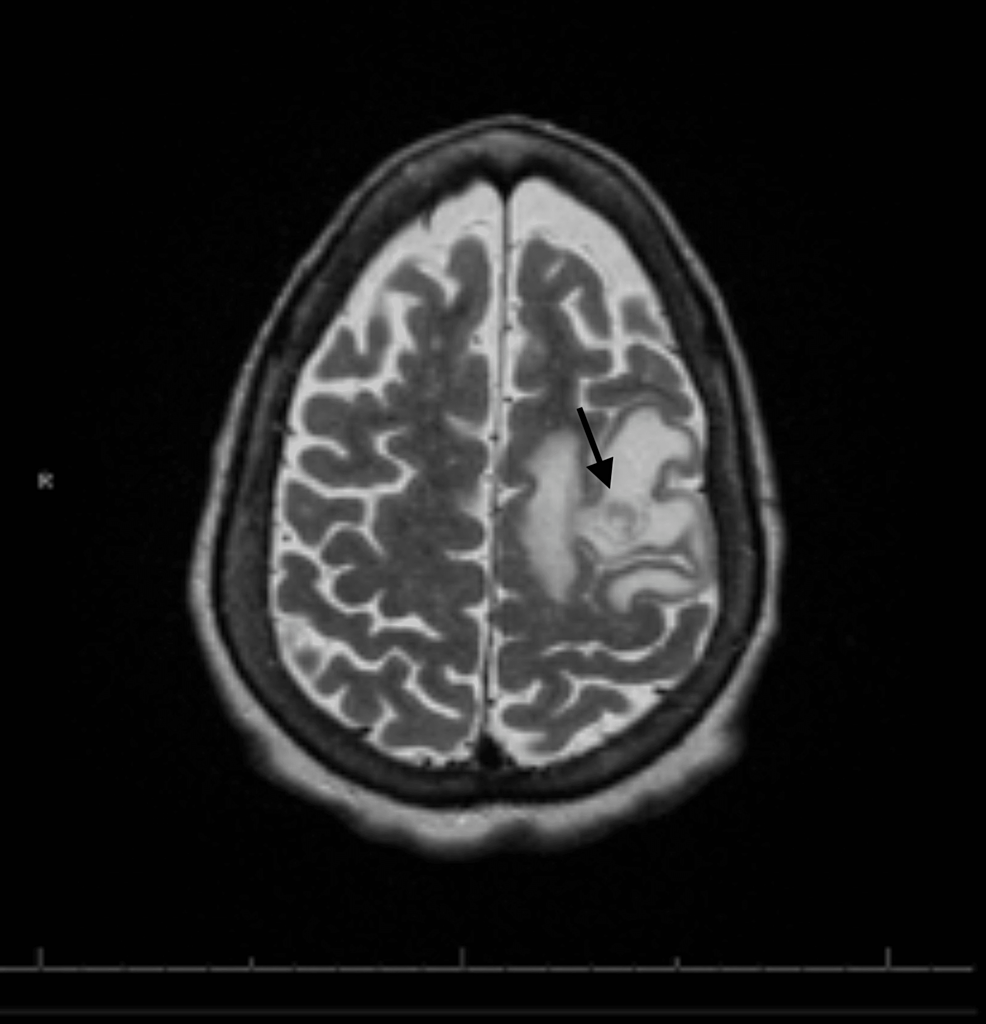Cureus Glioblastoma Multiforme in a Patient With Alpha1Antitrypsin Deficiency