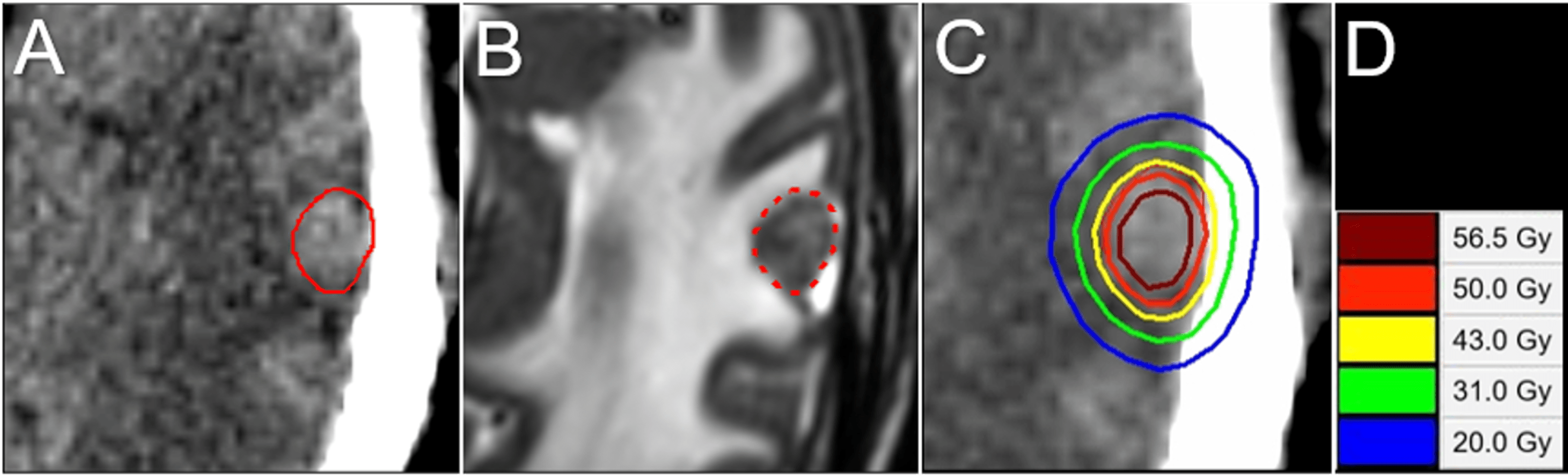 Five Fraction Stereotactic Radiosurgery With Non Contrast Enhanced Mri Based Target Definition 9450