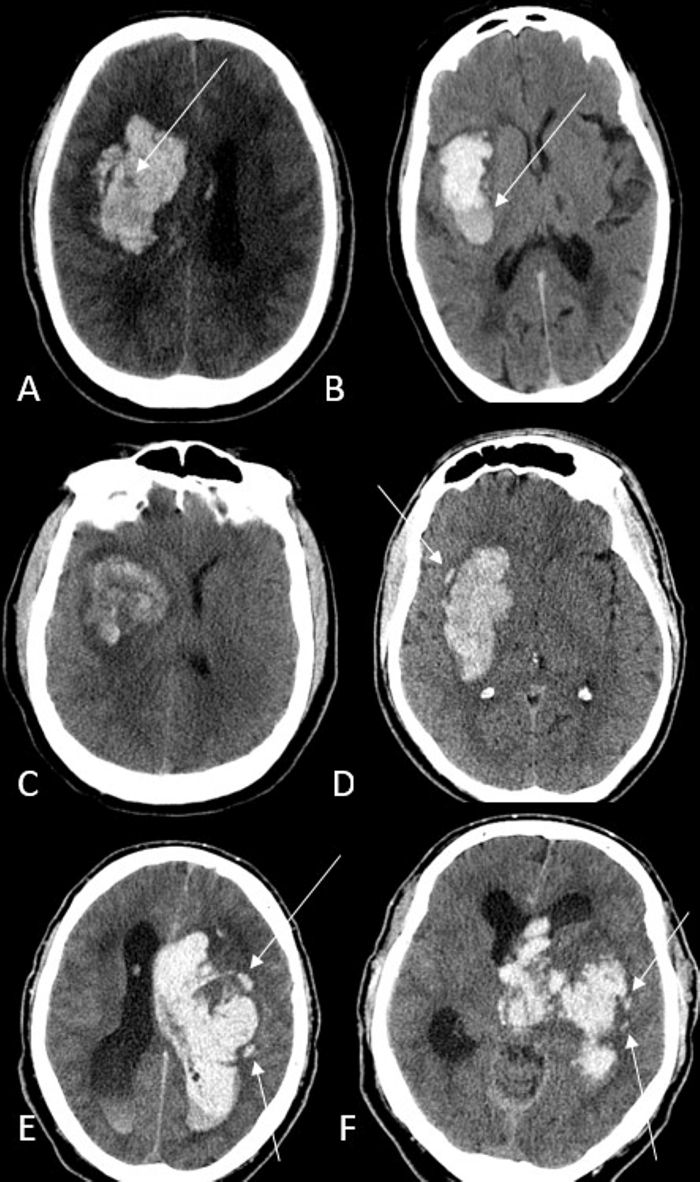 Figure2  Intraventricular Contrast Medium Leakage during Ethanol