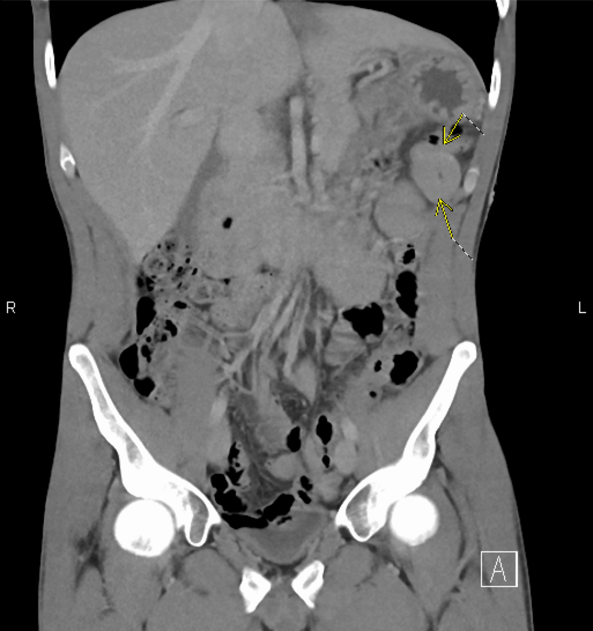 Cureus An Unusual Presentation Of Severe Sepsis Due To
