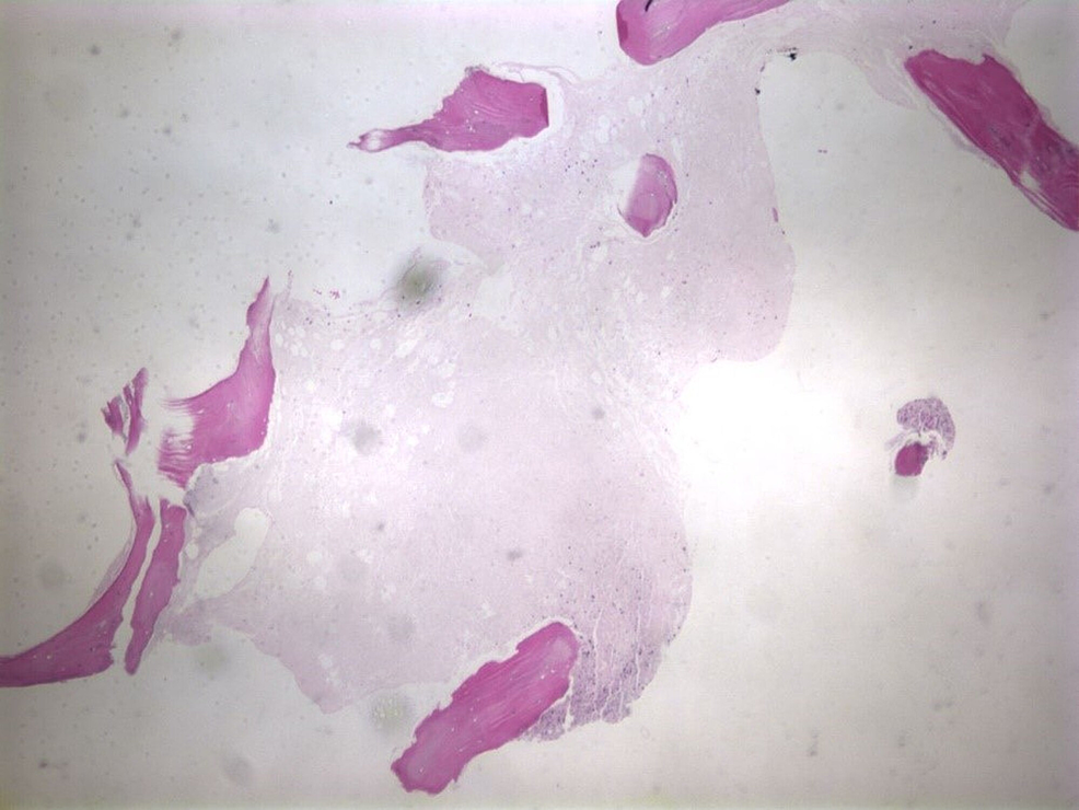 Cureus Extensive Bone Marrow Necrosis And Osteolytic Lesions In A