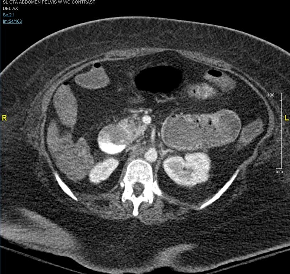 Ct Abdomen Pelvis Without Contrast Sexiezpix Web Porn