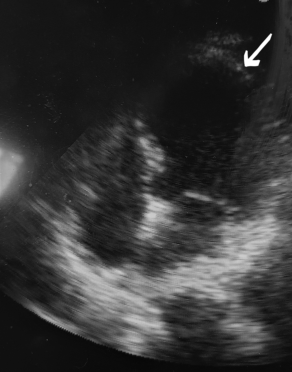 Cureus Takotsubo Cardiomyopathy in a Case of Intracerebral Hemorrhage