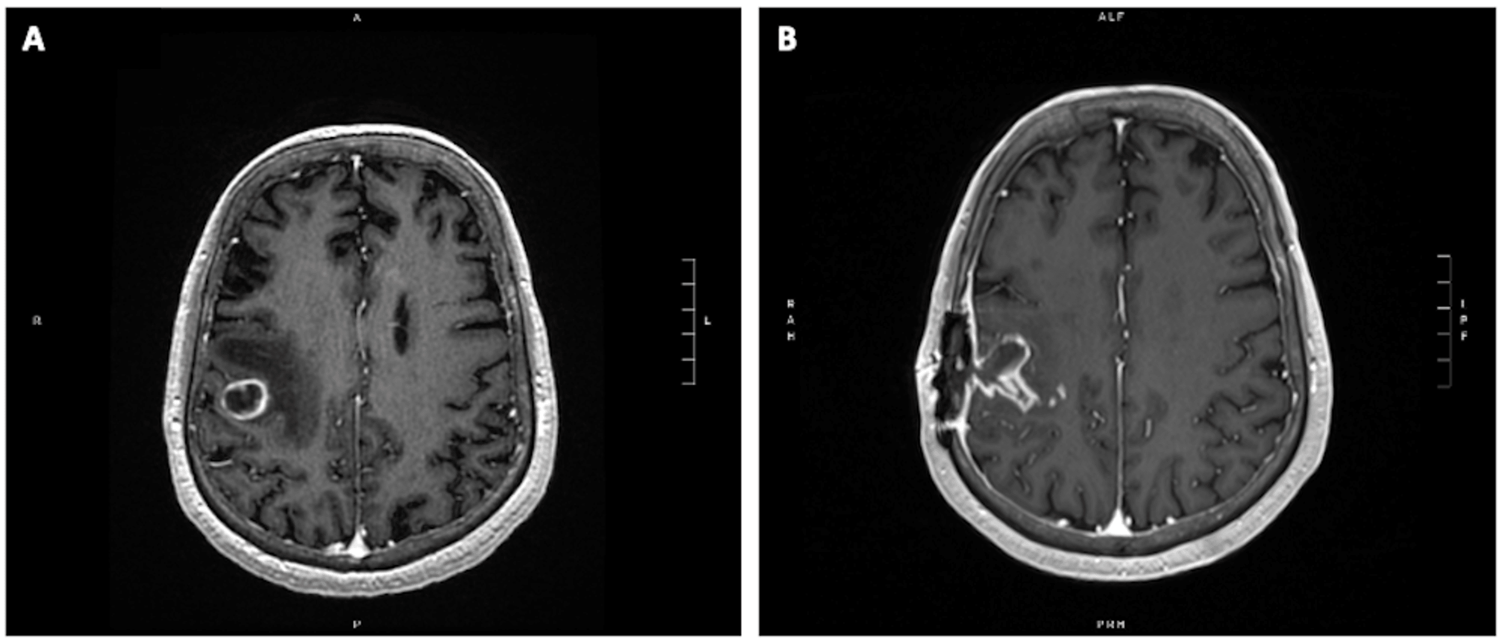 Stereotactic Radiosurgery for Brain Metastases in Patients With a