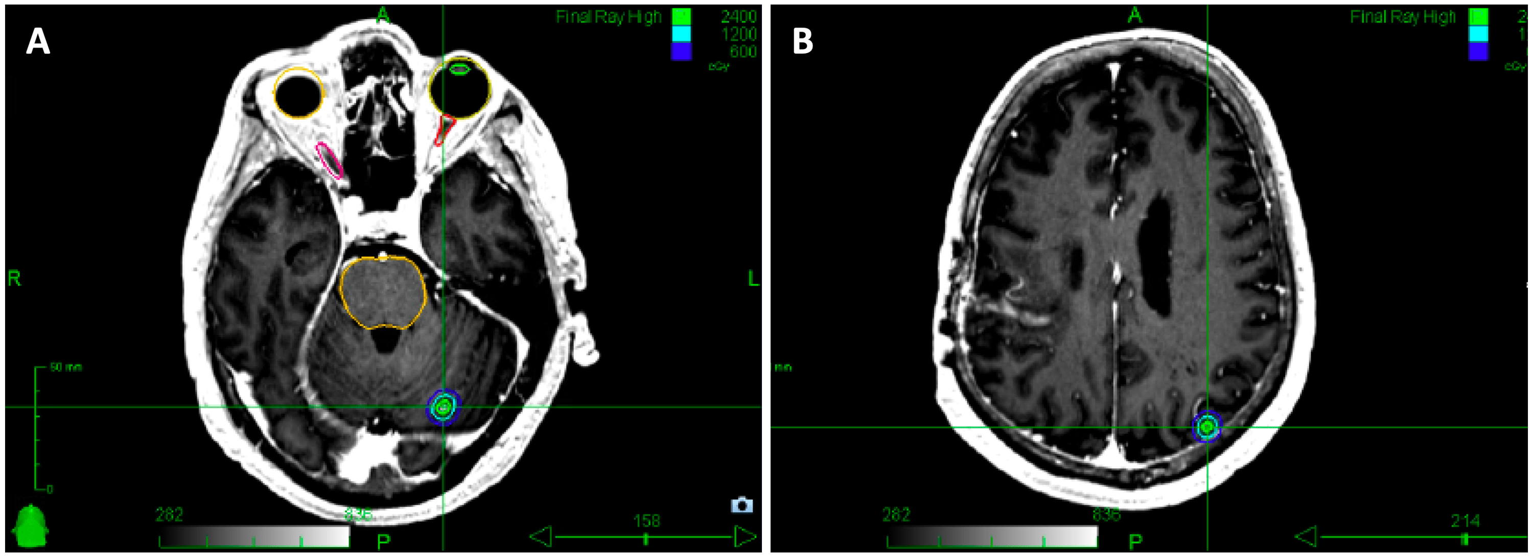 Stereotactic Radiosurgery for Brain Metastases in Patients With a