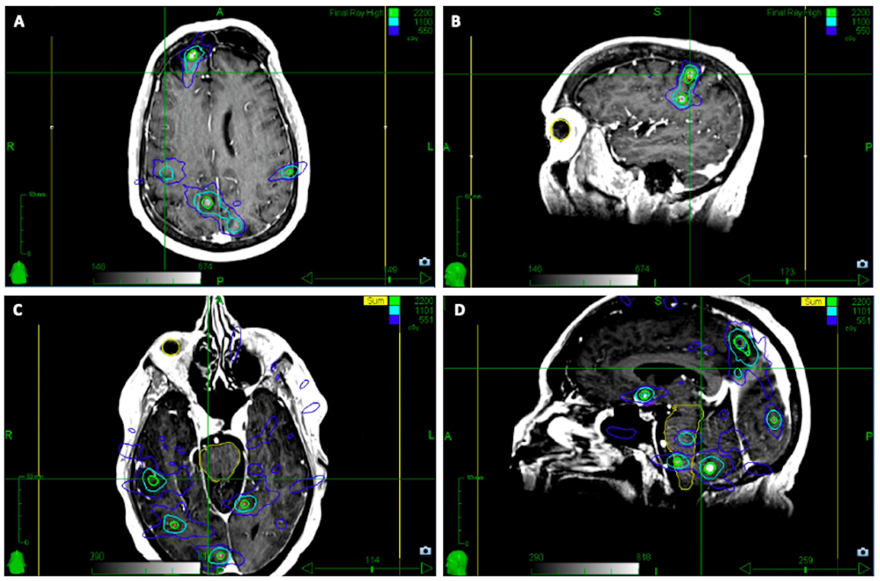 Stereotactic Radiosurgery for Brain Metastases in Patients With a